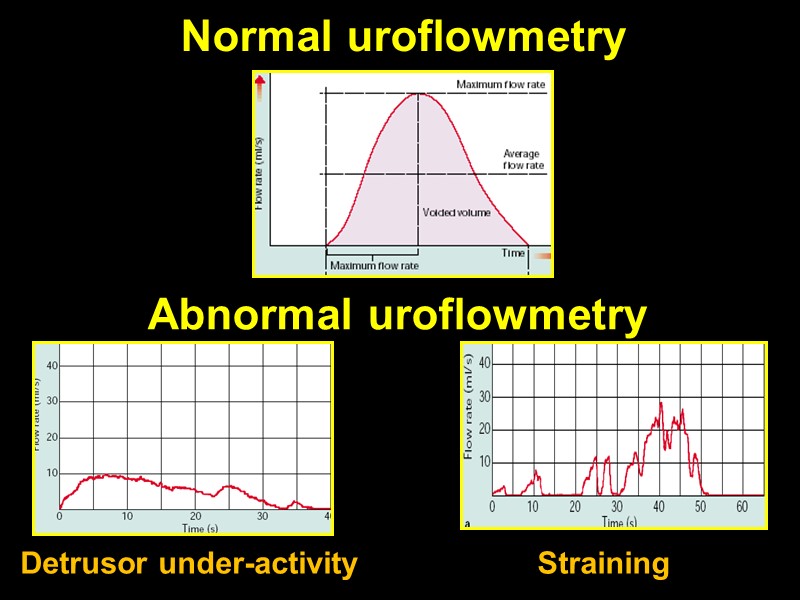 Normal uroflowmetry Abnormal uroflowmetry Straining Detrusor under-activity